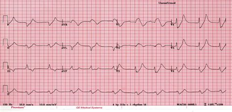 litfl|litfl hyperkalaemia.